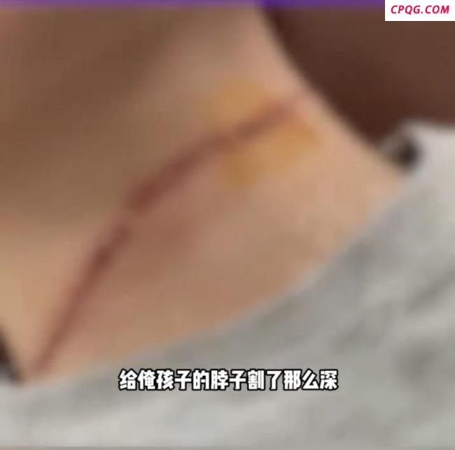17岁男孩骑车时遭“割喉”