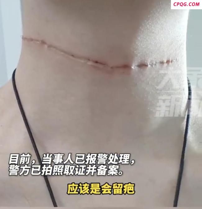 17岁男孩骑车时遭“割喉” 风筝线成隐形利刃