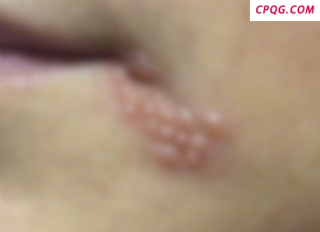 女子回应唱K感染病毒 8年反复发作苦不堪言