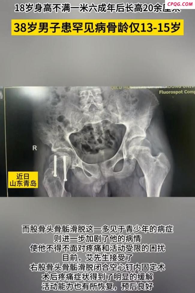 男子成年后长高20cm确诊罕见病 罕见病症组合引发关注