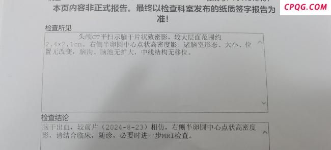 脑干出血程序员晒康复前后对比 从ICU到重新行走的历程