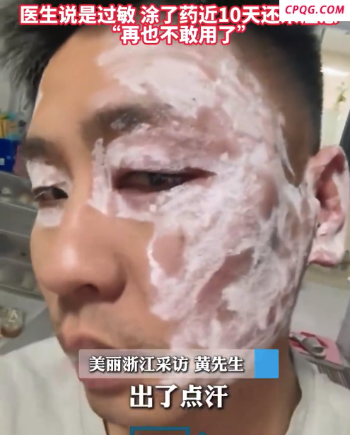 男子用餐馆纸巾擦汗后险毁容，过敏10天还未痊愈