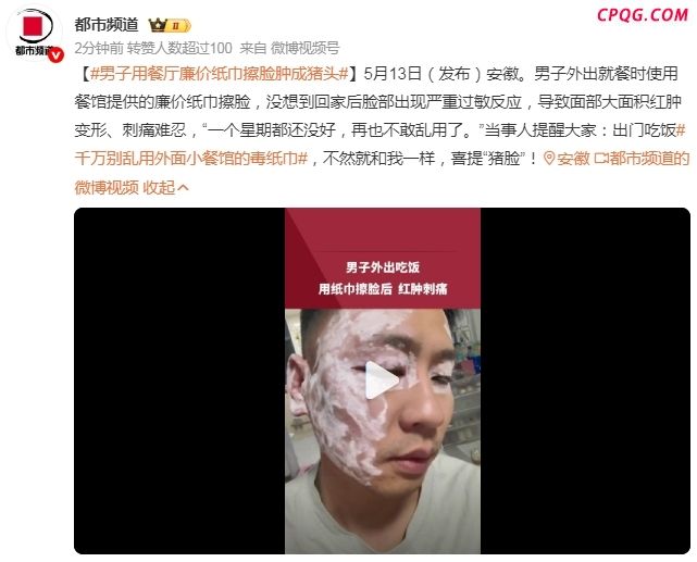 男子用餐厅毒纸巾擦脸险毁容