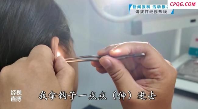 女童耳痛就医挖出所藏橡皮擦 两年“耳中秘密”揭晓