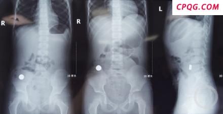 男孩吞服2枚磁铁致4处肠穿孔 紧急手术挽救生命