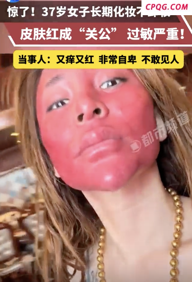 37岁女子长期不卸妆皮肤出问题 22年未卸妆引发严重过敏