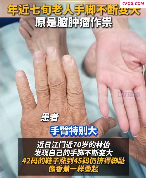 老人年近七旬手脚还在长大