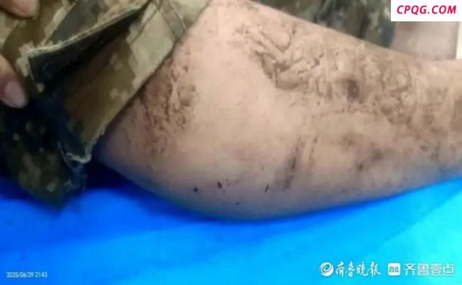 男子抓蝎子被蜇伤意识丧失 精准施救挽回一命