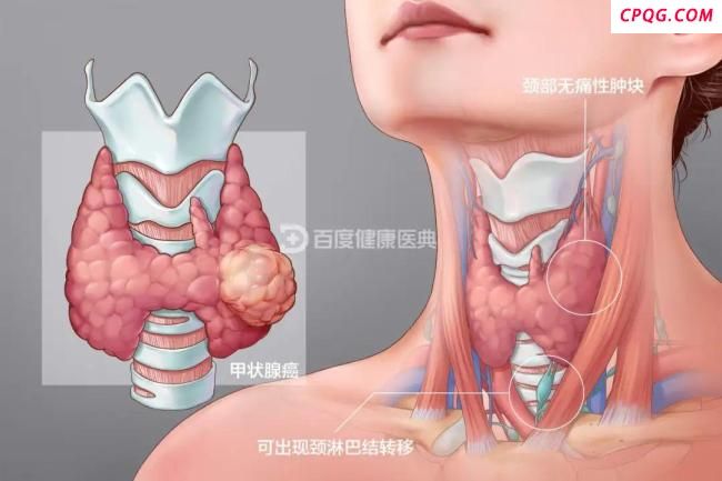 女子长期情绪内耗确诊甲状腺癌