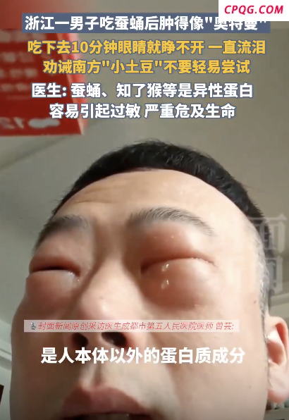 一直流泪 男子吃蚕蛹后肿得像“奥特曼” 奇异反应引热议