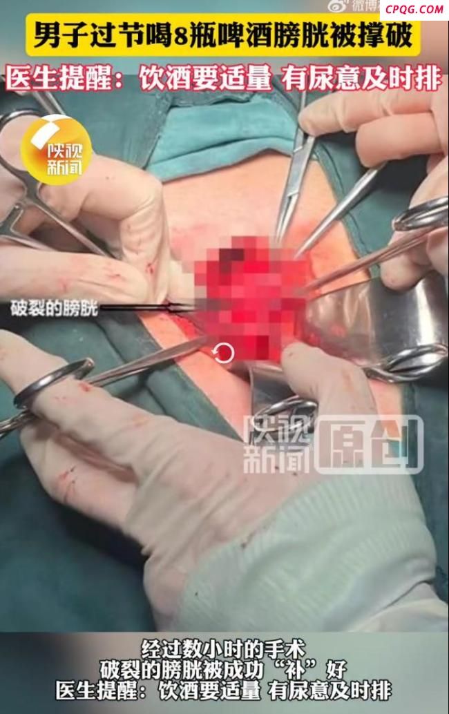 男子豪饮8瓶啤酒膀胱被撑破 饮酒需适量